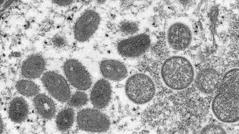 19nyc-monkeypox1-superJumbo