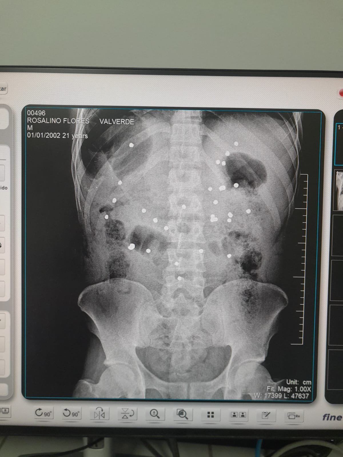 Radiografía del tórax y pelvis de Rosalino Flores Valverde. Imagen: José Victor Salcedo.