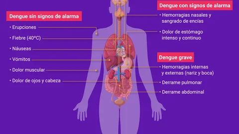 SIGNOS DENGUE