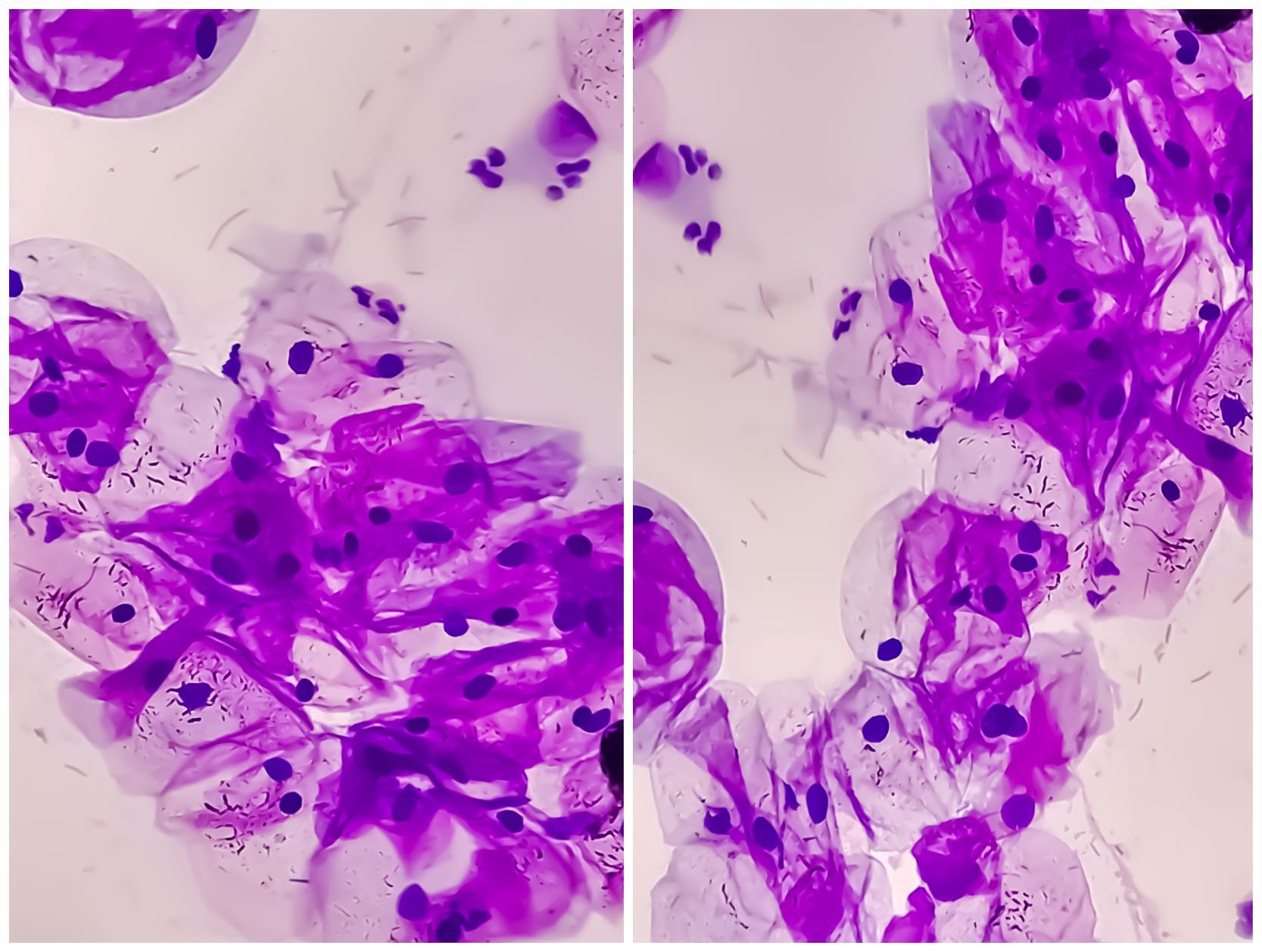 cancerdecuellouterino_Portada