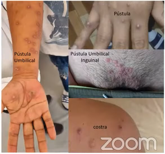 viruela del mono casos minsa